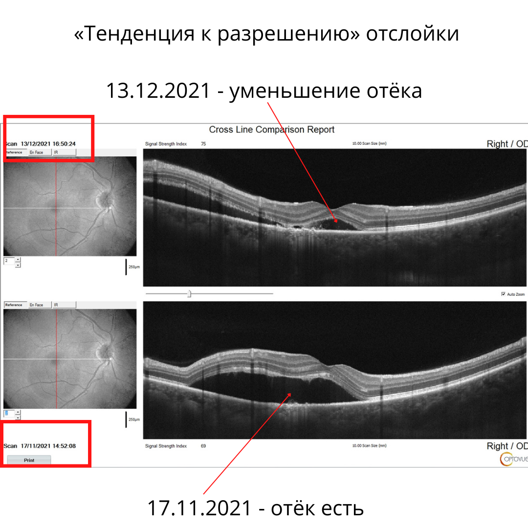 Тенденция к разрешению сетчатки